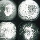 Choroiditis Choroiditis